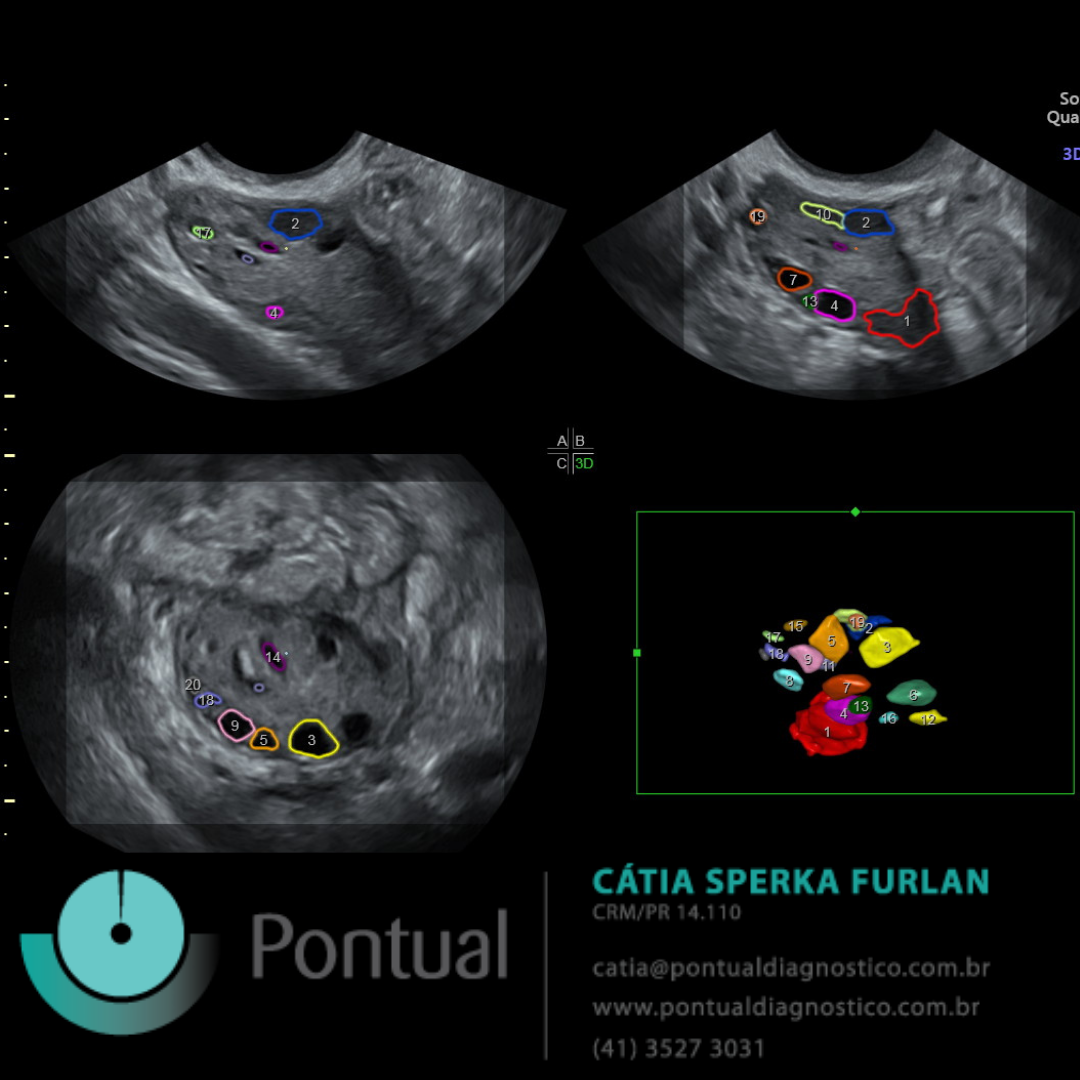 Ultrassonografia Transvaginal em 3 D para Controle de Ovulação